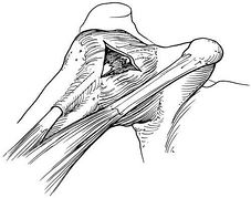 Does a rotator cuff tear have to be repaired with open surgery?