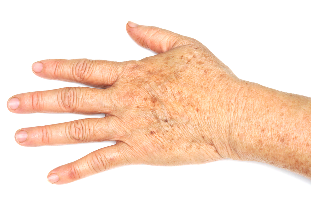 are-my-dark-spots-associated-with-my-arthritis-azalea-orthopedics