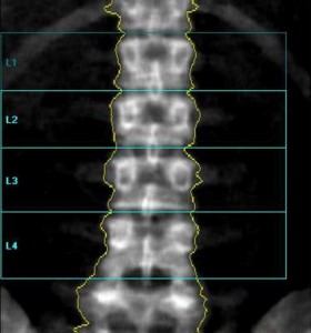 A density analysis of your X-rays can lead to early osteoporosis detection.